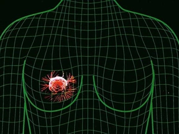 Daugiau nei fibroadenomatosis yra pavojingas